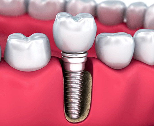 Implante Dentarios